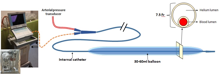 Schematic design of IABP catheter